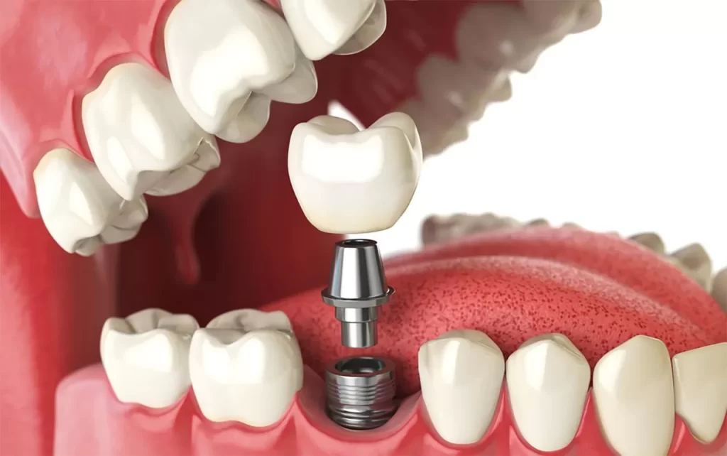 Quem Pode Fazer Implante Dentário