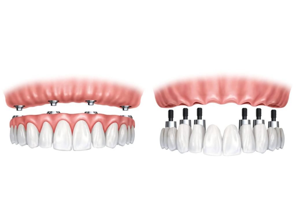 Dentista mostrando planejamento de prótese protocolo para paciente em consultório