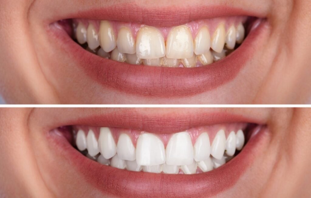 Clareamento Dental em Cascavel