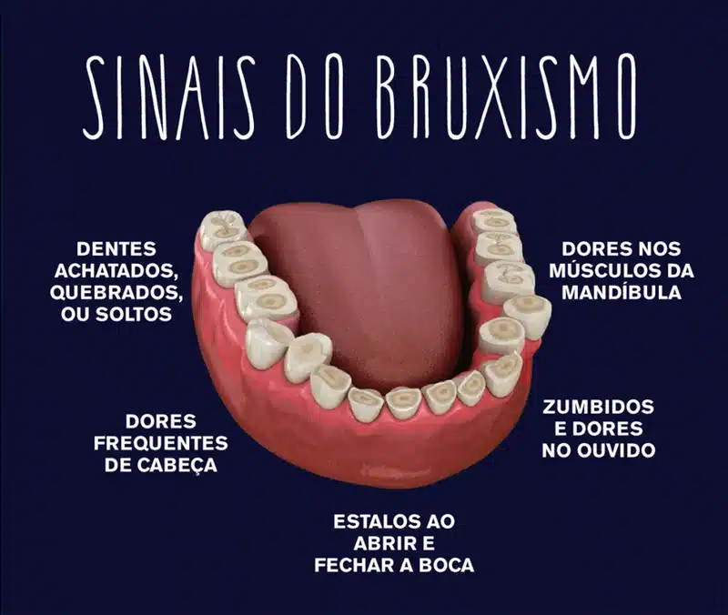 Sinais do Bruxismo